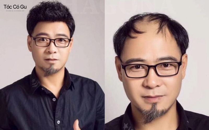 Nguyên tắc chọn kiểu tóc cho nam trán hói