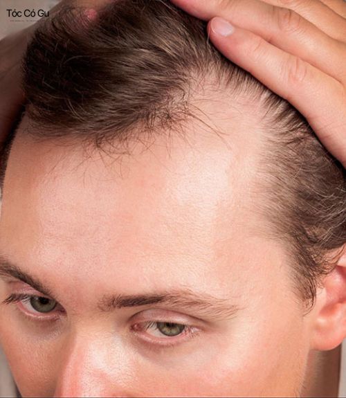 Trán chữ M có dấu hiệu tóc thưa ở hai bên thái dương