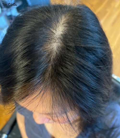 10 kiểu tóc cho tóc mỏng xẹp, thưa đẹp giúp tóc trông dày hơn Cận cảnh da đầu bị lộ do tình trạng tóc mỏng thưa ở nữ giới.